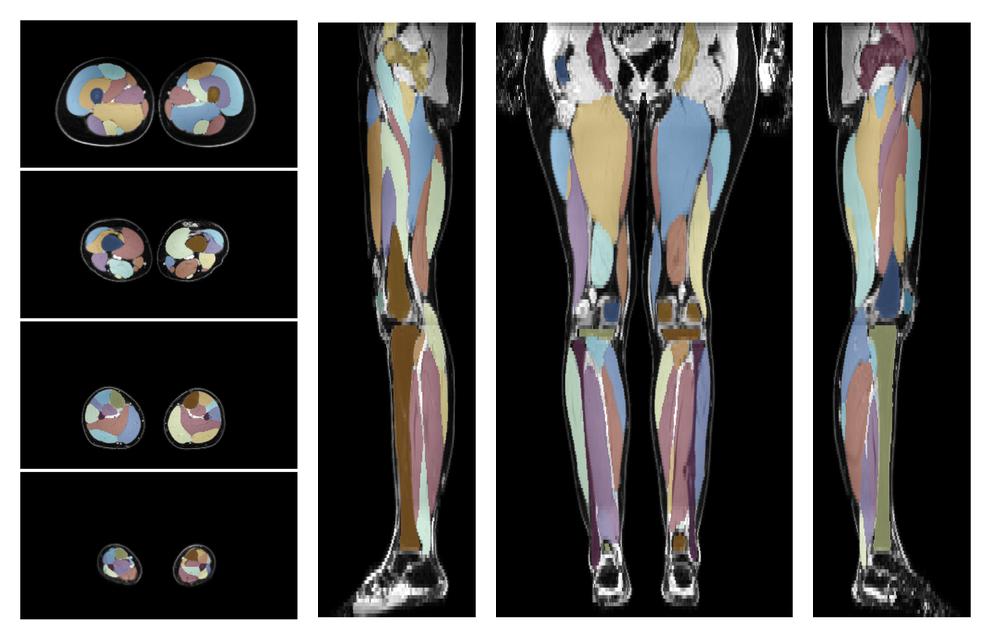 Overlay of automated muscle segmentation labels on dixon water image.